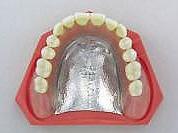 総入れ歯金属床義歯