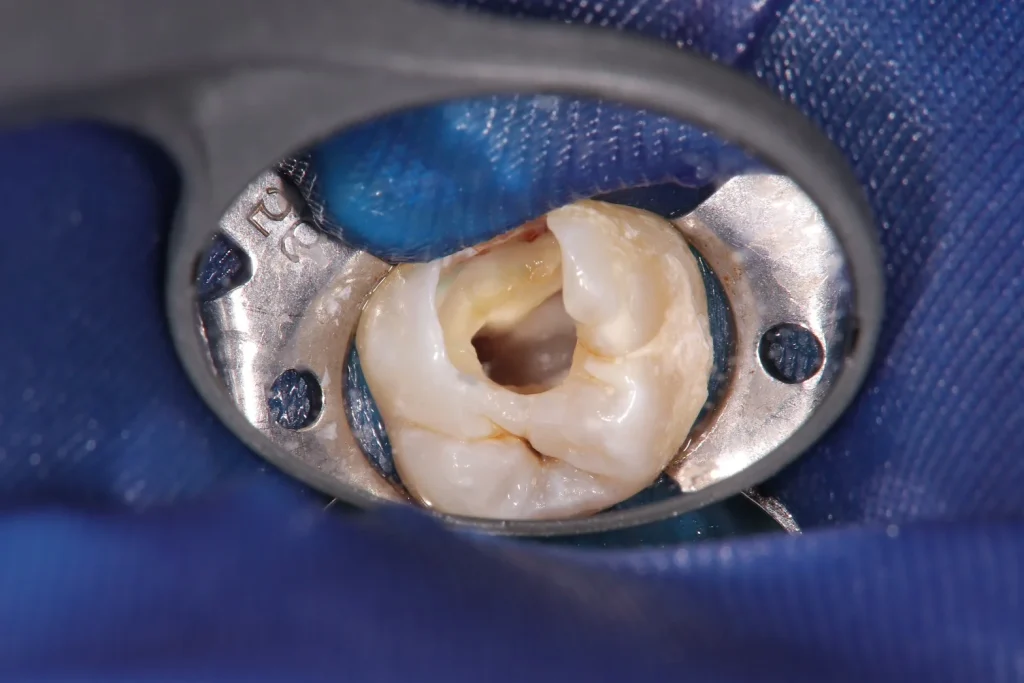 高倍率拡大鏡を使用した根管治療