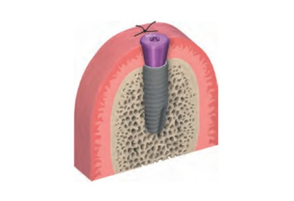 二次手術（インプラントの支台設置）