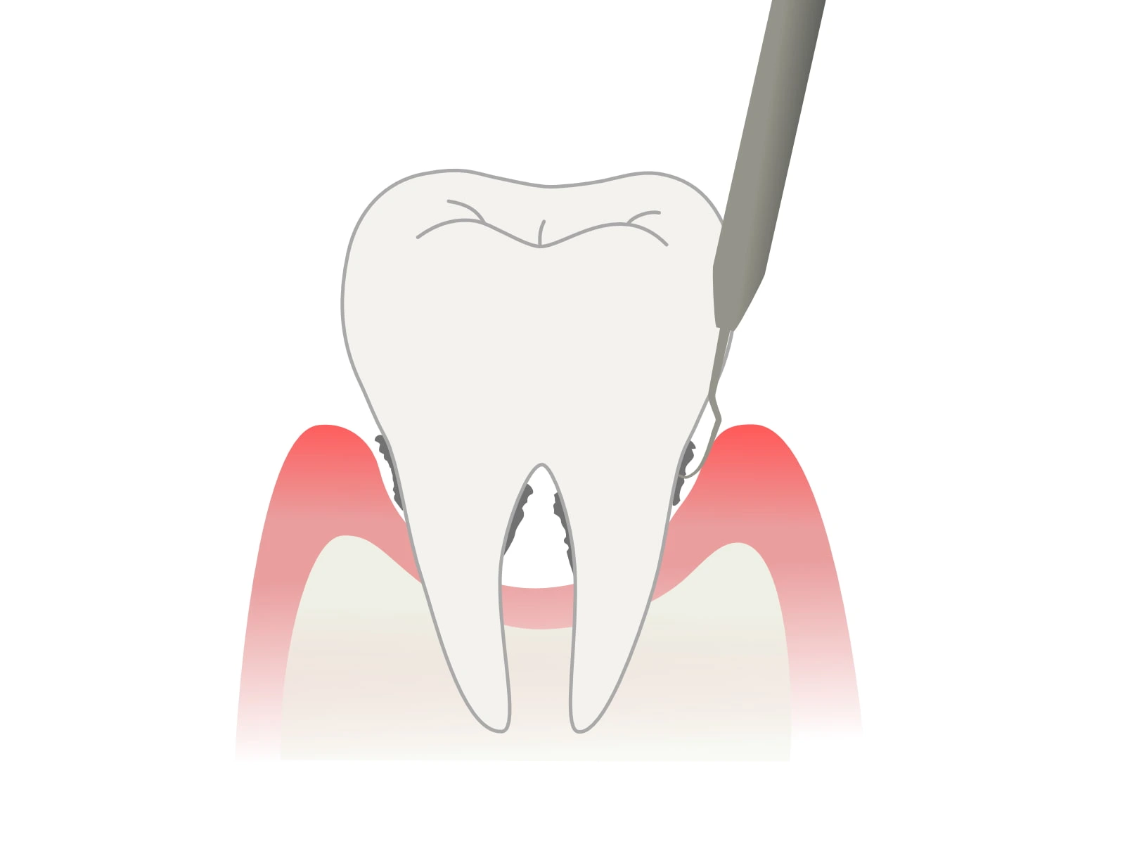 歯垢除去・スケーリング