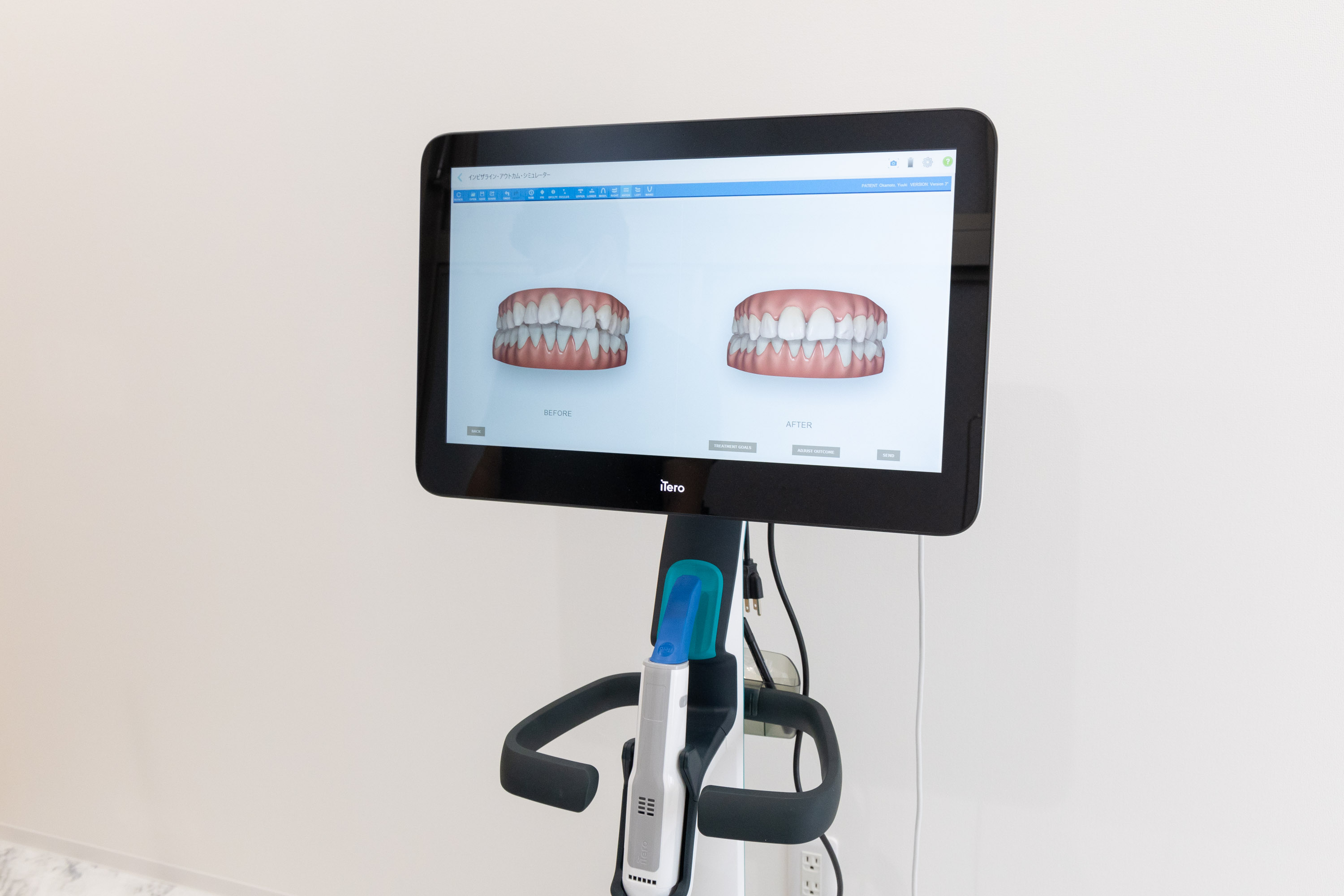 iTeroスキャナー